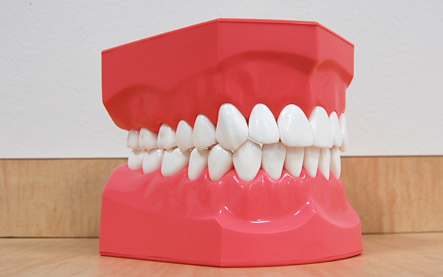 歯並びは歯周病を悪化させる原因になります